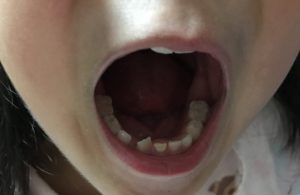 乳歯がグラグラ 大人の歯が生えてきたらどうする 歯並びがいい子ほど歯医者に行け はれとぶろぐ